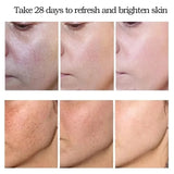 Improve Dullness Remove Dark Spot Brighten Effective Whiten Freckle Cream Melasma Fade Melanin Anti-Pigmentation Face Skin Care